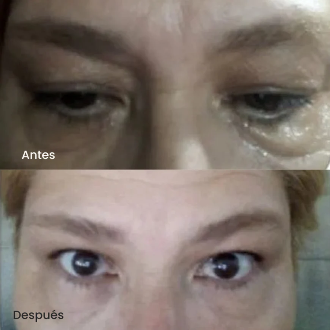 Roller Anti-Ojeras con Ácido Hialurónico