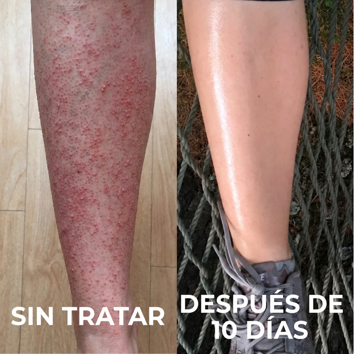 Complejo avanzado de triple ácido para la queratosis pilaris