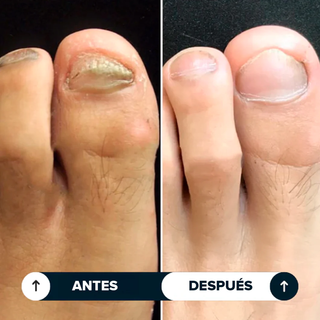 Biocenti | Lápiz Antihongos