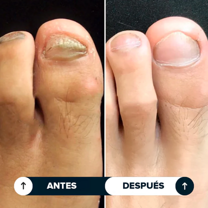 Biocenti | Lápiz Antihongos