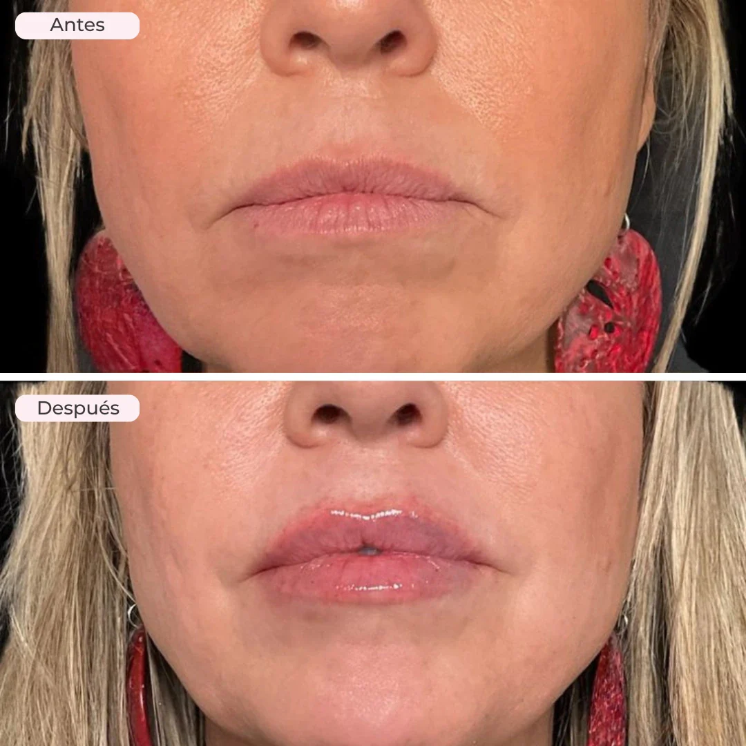 Sérum Voluminizador de Labios de Biocenti