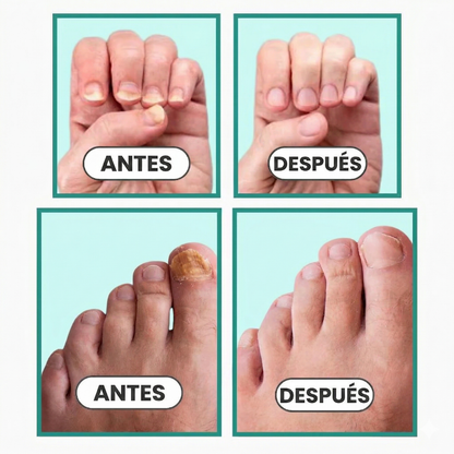 Dispositivo Láser Antihongos para Uñas