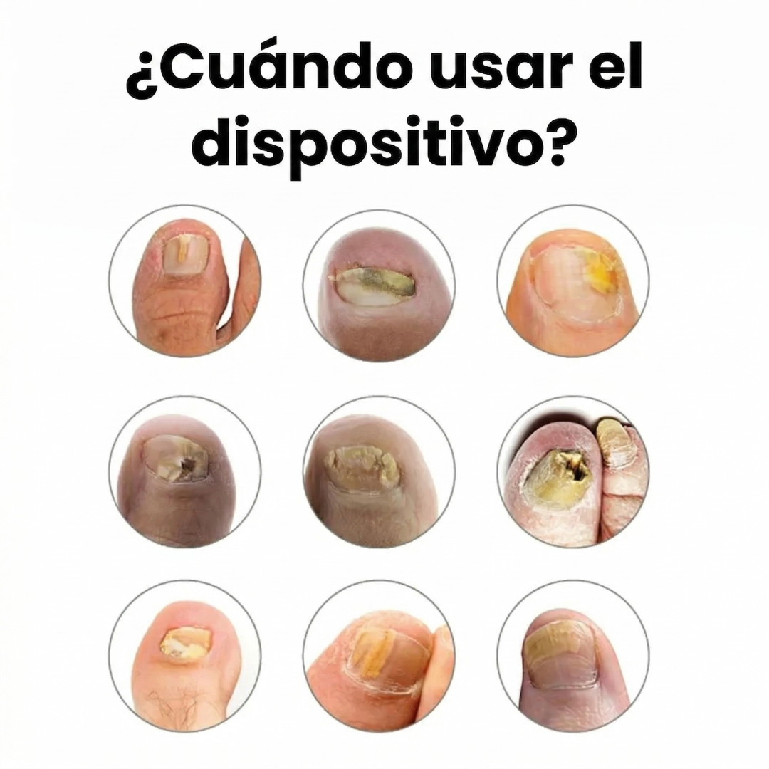 Dispositivo Láser Antihongos para Uñas