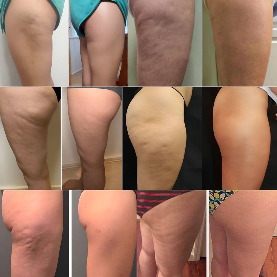 Resultados del aceite anticelulitis