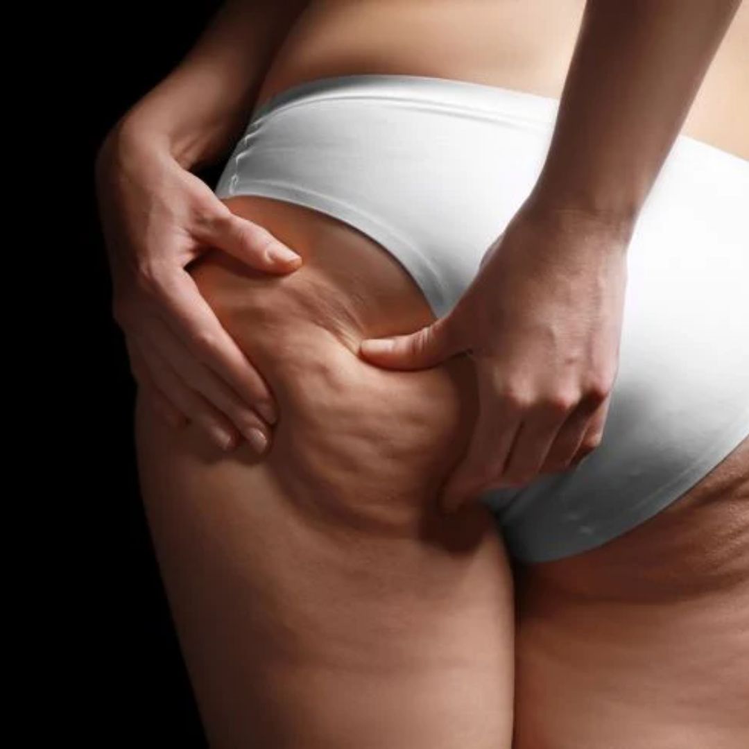 Celulitis sin tratar