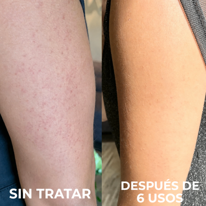 Complejo avanzado de triple ácido para la queratosis pilaris