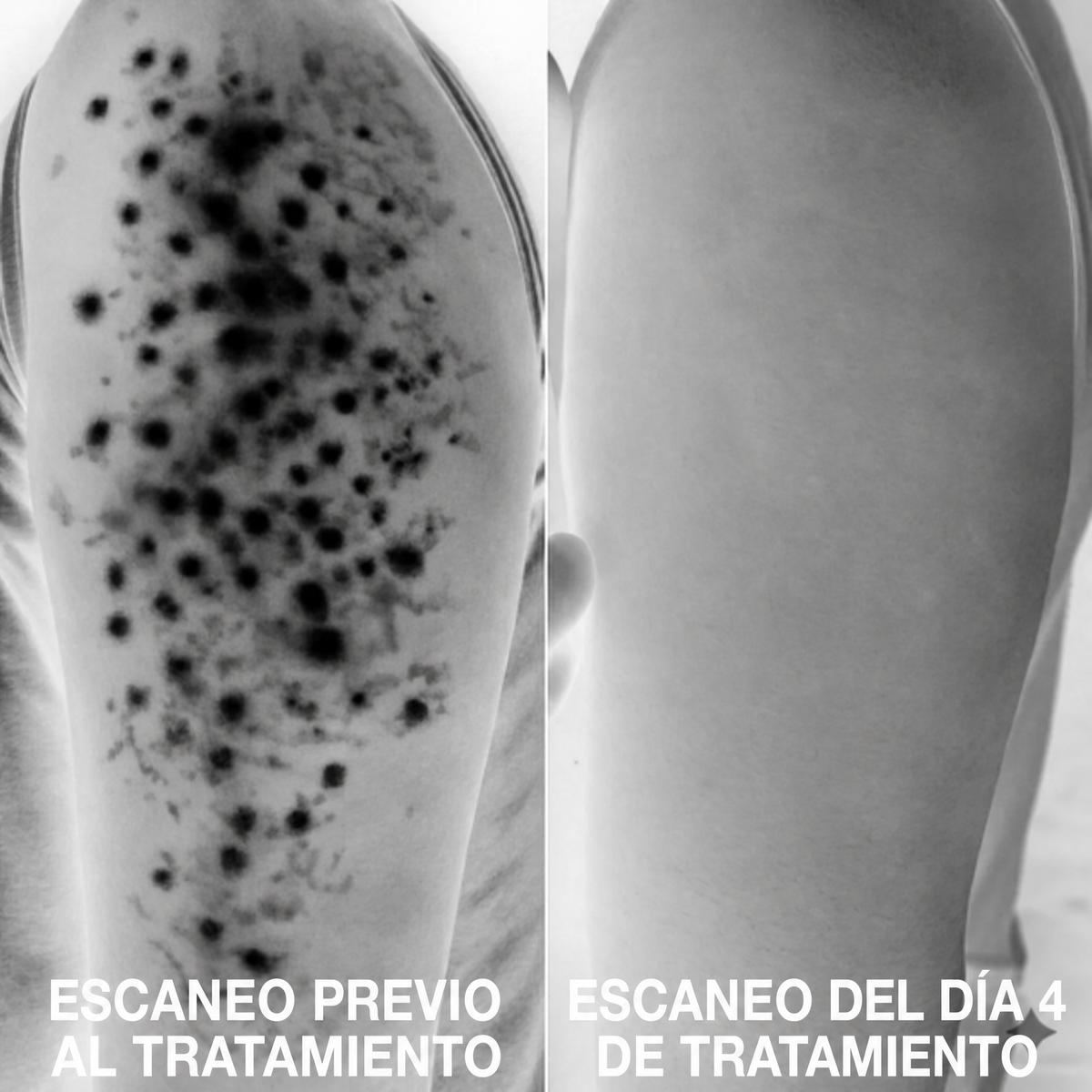 Complejo avanzado de triple ácido para la queratosis pilaris