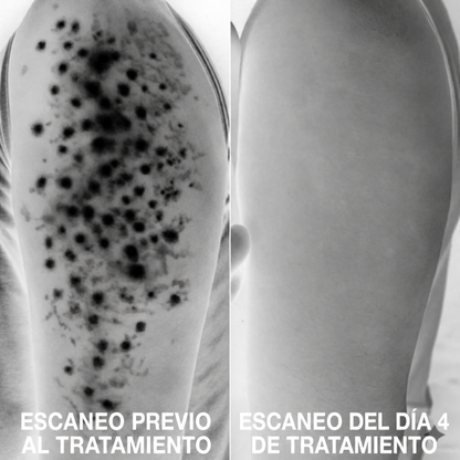 Complejo avanzado de triple ácido para la queratosis pilaris