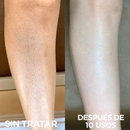 Complejo avanzado de triple ácido para la queratosis pilaris